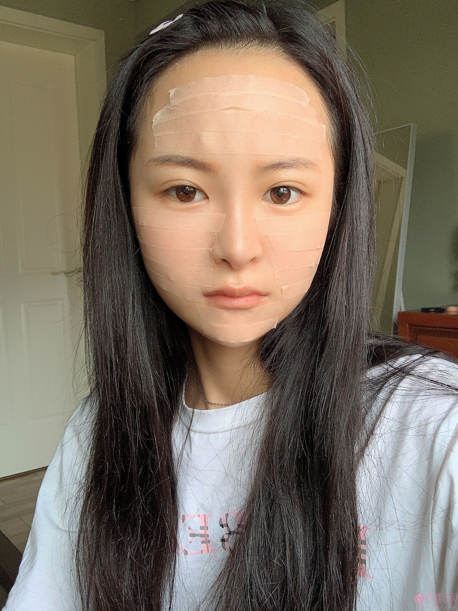 成都赵善军博士整形自体脂肪全脸填充好不好?2020价格表出炉+填充案例前后对比