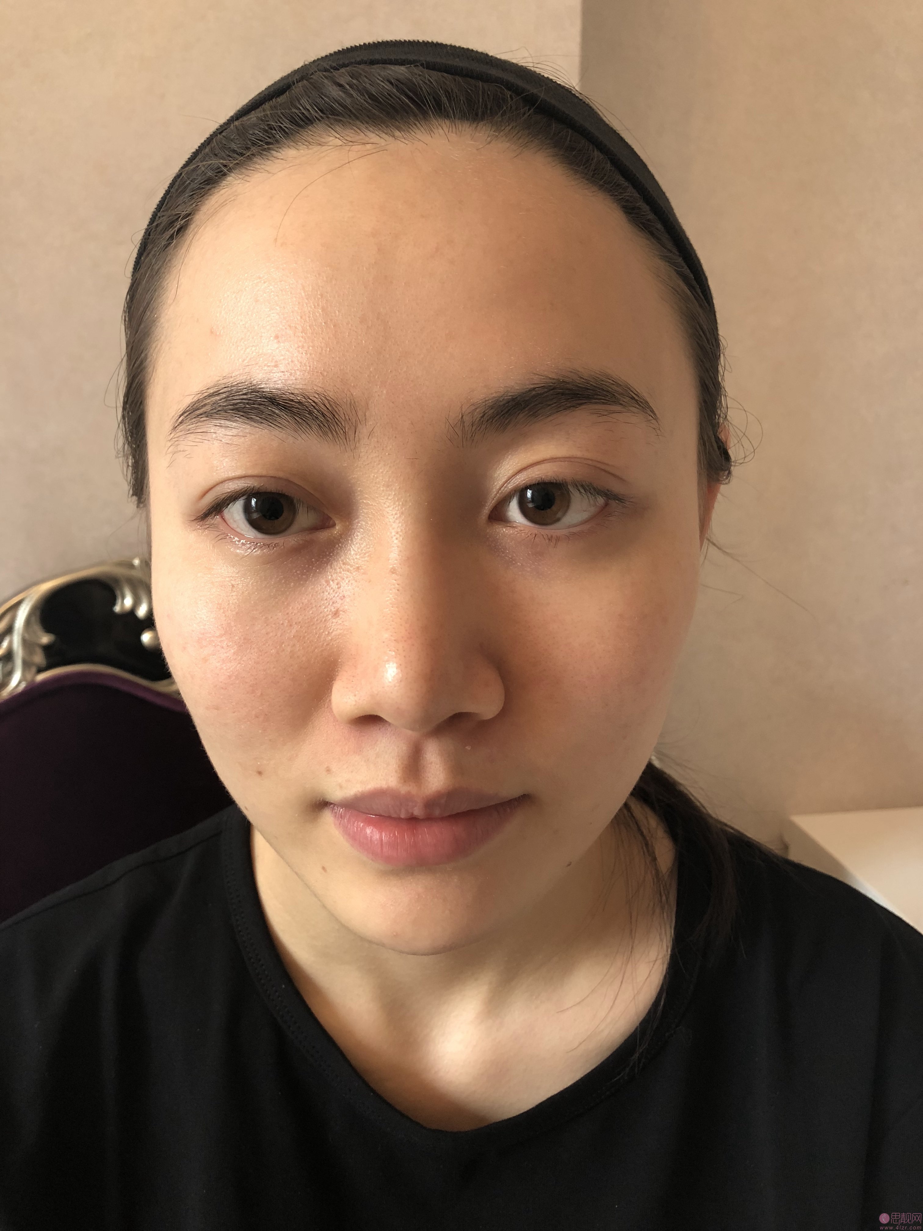 成都忠爱美成医疗美容医院彭忠隆鼻怎么样？2020价格表一览+隆鼻案例对比