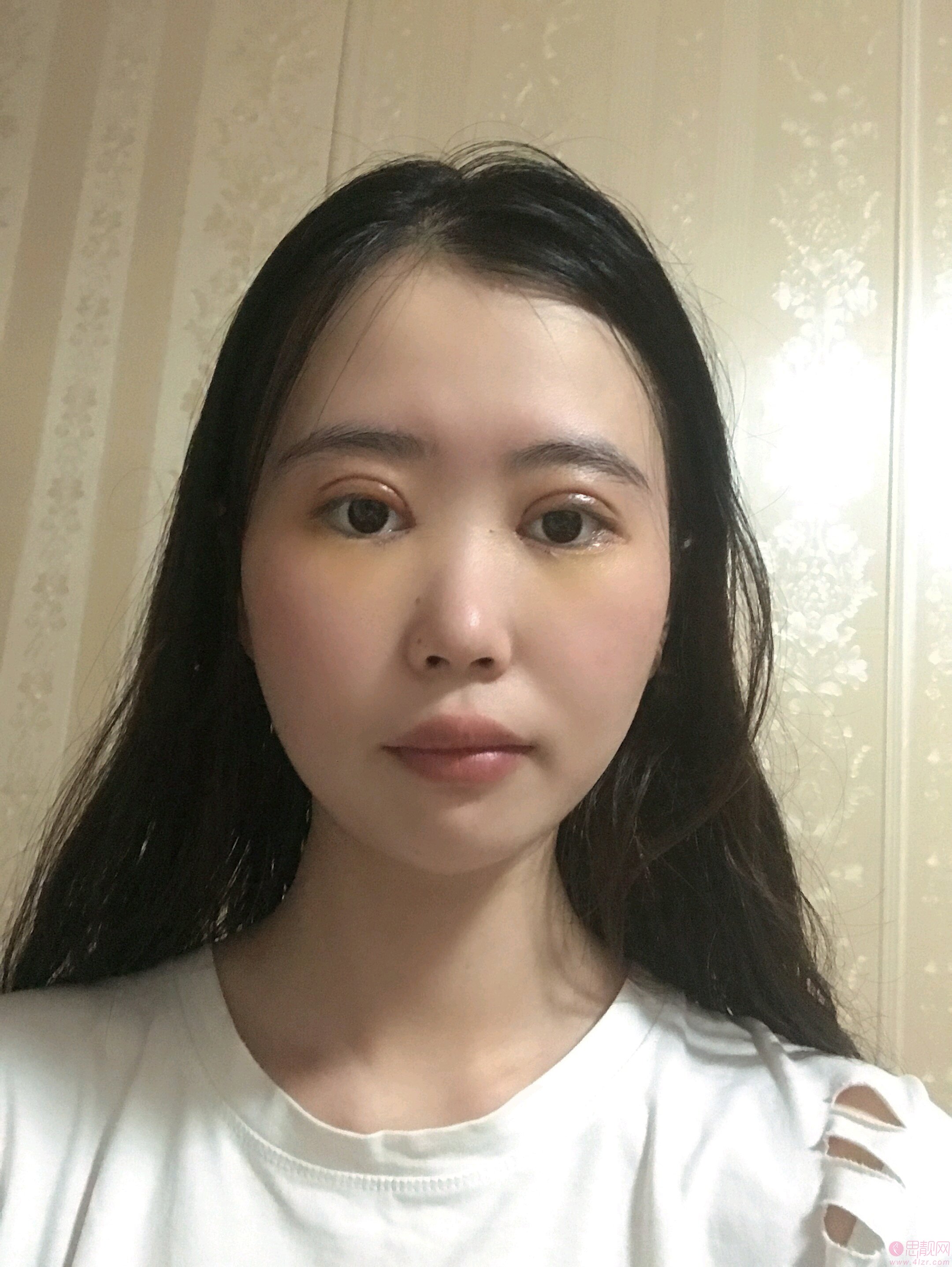 福州格莱美美容医院任正义做双眼皮怎么样?附2020价格表一览+双眼皮案例对比
