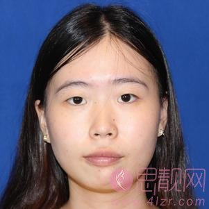 福州格莱美美容医院任正义做双眼皮怎么样?附2020价格表一览+双眼皮案例对比