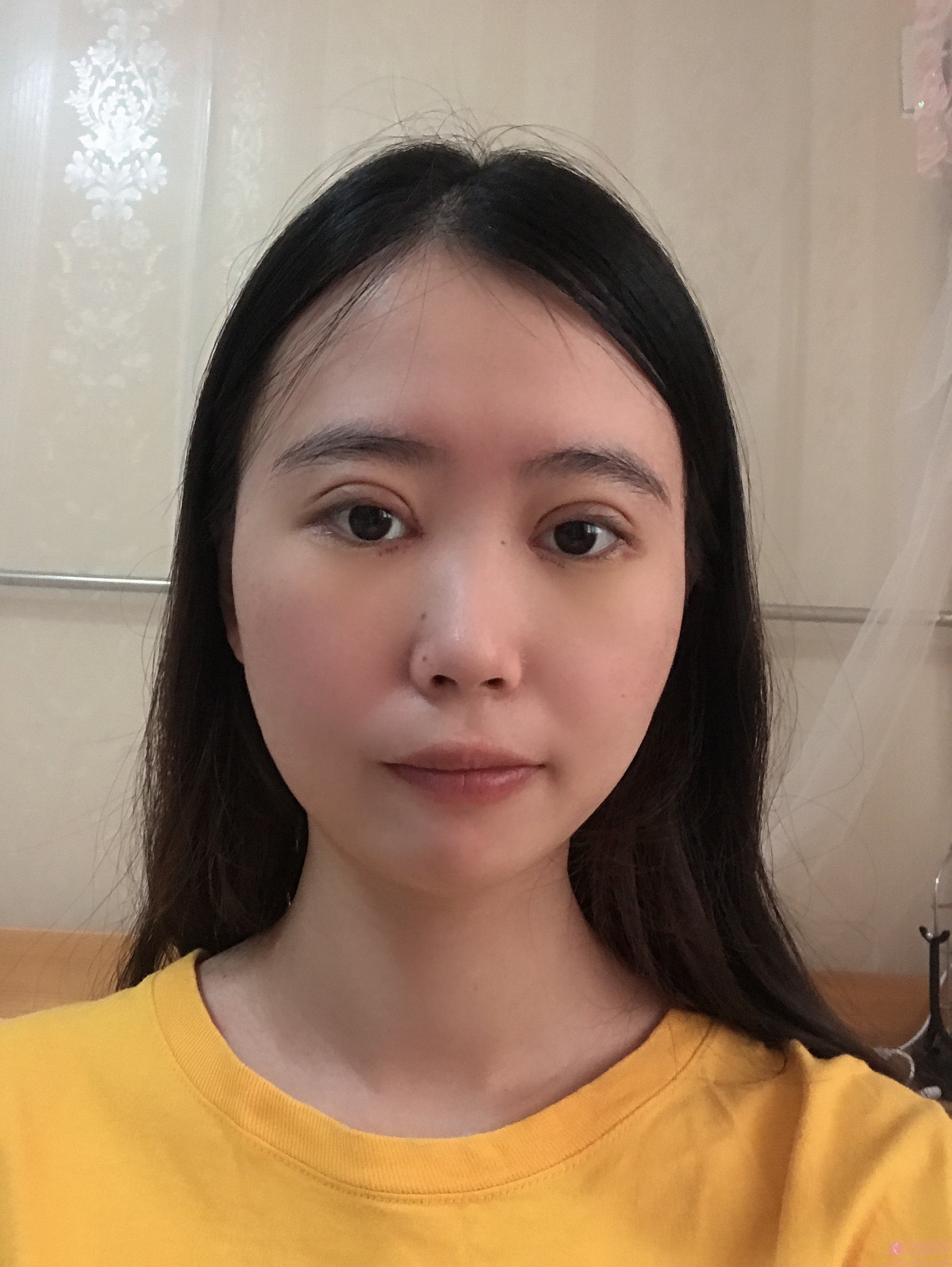 福州格莱美美容医院任正义做双眼皮怎么样?附2020价格表一览+双眼皮案例对比