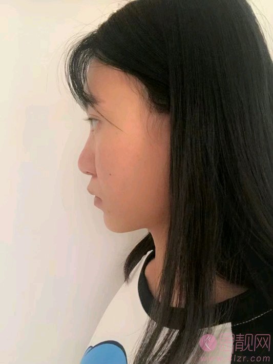 福州韩尔医疗美容医院孟鹏勃隆鼻怎么样？附隆鼻案例及2020价格表一览