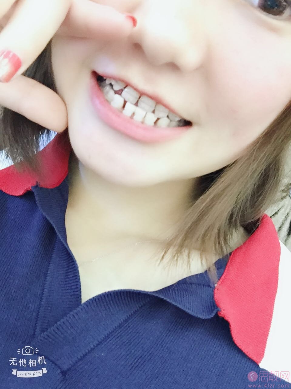 北京瑞齿口腔姜涛医生隐形矫正怎么样？附矫正前后案例对比及2020最新价格表一览