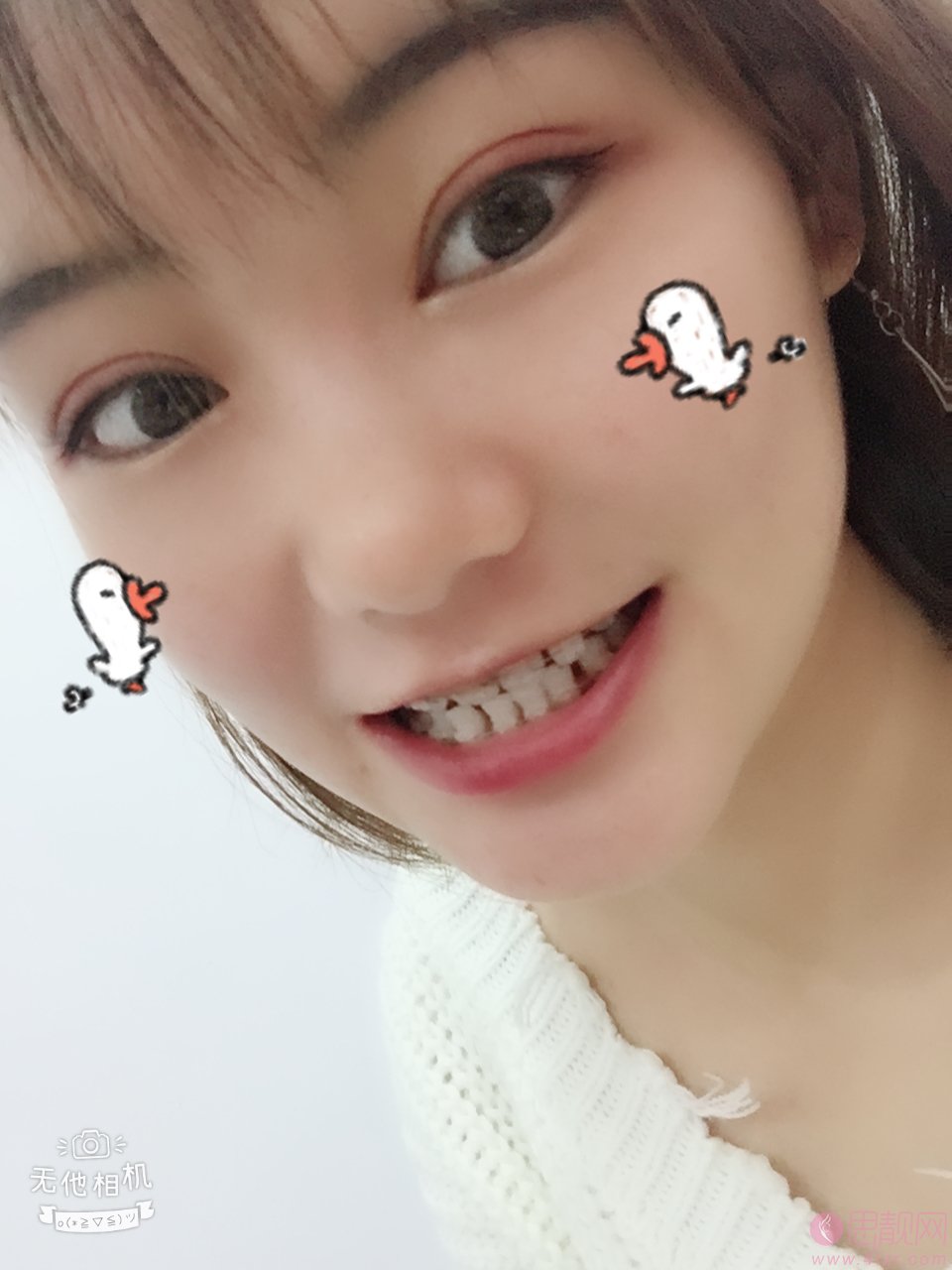 北京瑞齿口腔姜涛医生隐形矫正怎么样？附矫正前后案例对比及2020最新价格表一览