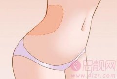 腰腹部吸脂对怀孕有没有影响?