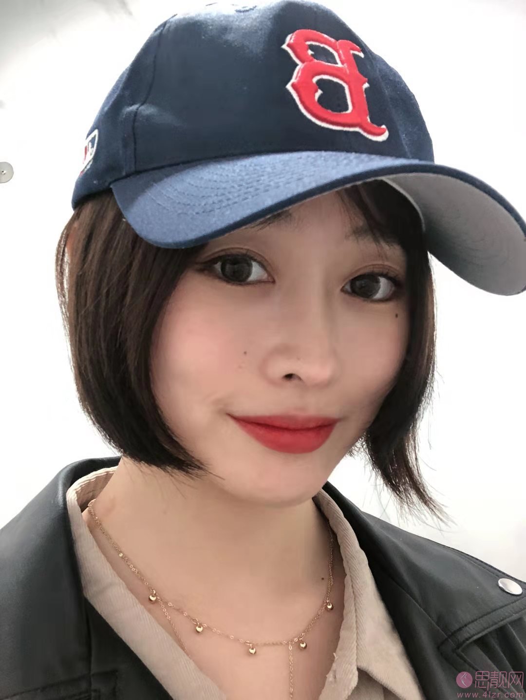 福州伊薇医疗整形隆鼻怎么样？附隆鼻案例前后对比及220全新价格表上线