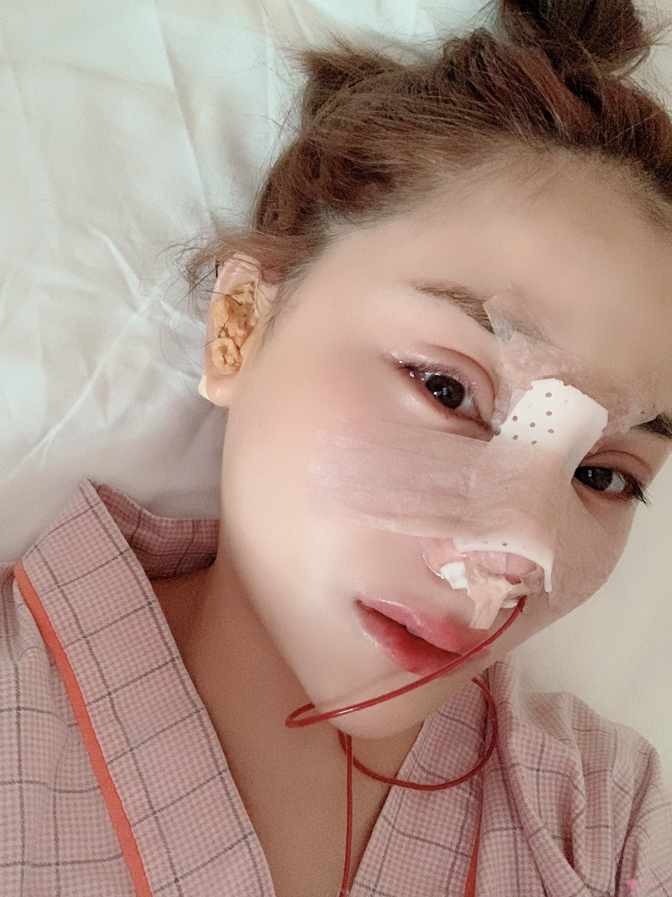 厦门海峡医疗美容张宏隆鼻怎么样?附隆鼻案例前后对比及2020价格表一览