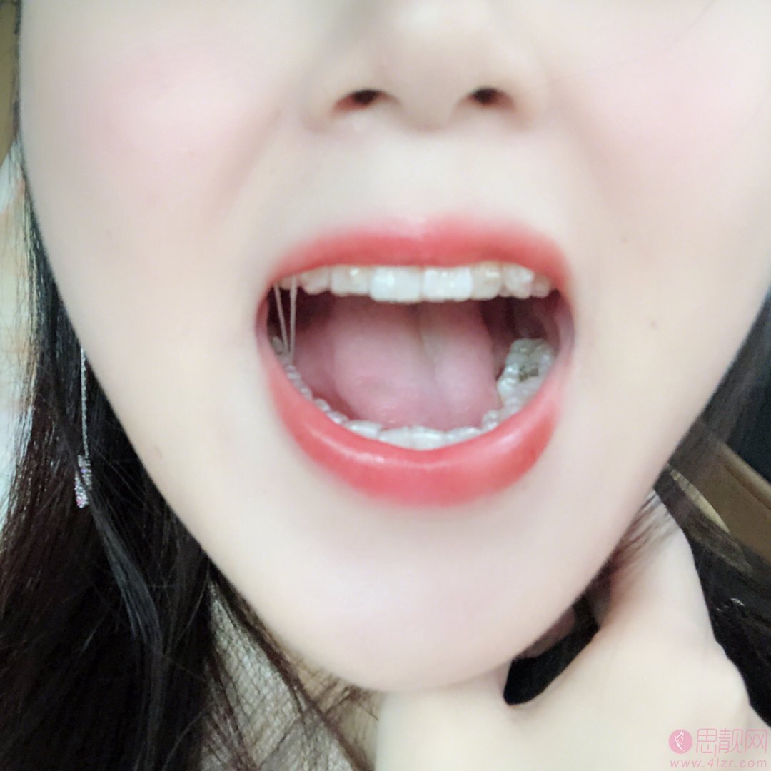 佛山华美口腔邵万村牙齿矫正怎么样？附矫正案例一览+2020全新价格表曝光