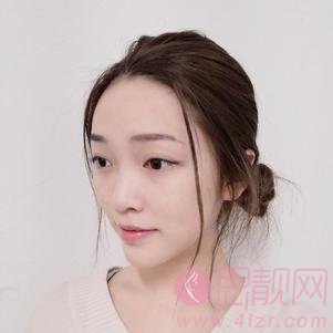 厦门思明欧菲美容医院隆鼻好不好，附隆鼻案例对比及2020价格表曝光