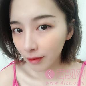 厦门云艺美整形外科门诊部刘爱茹做双眼皮怎么样?附双眼皮前后对比及2020价格表一览