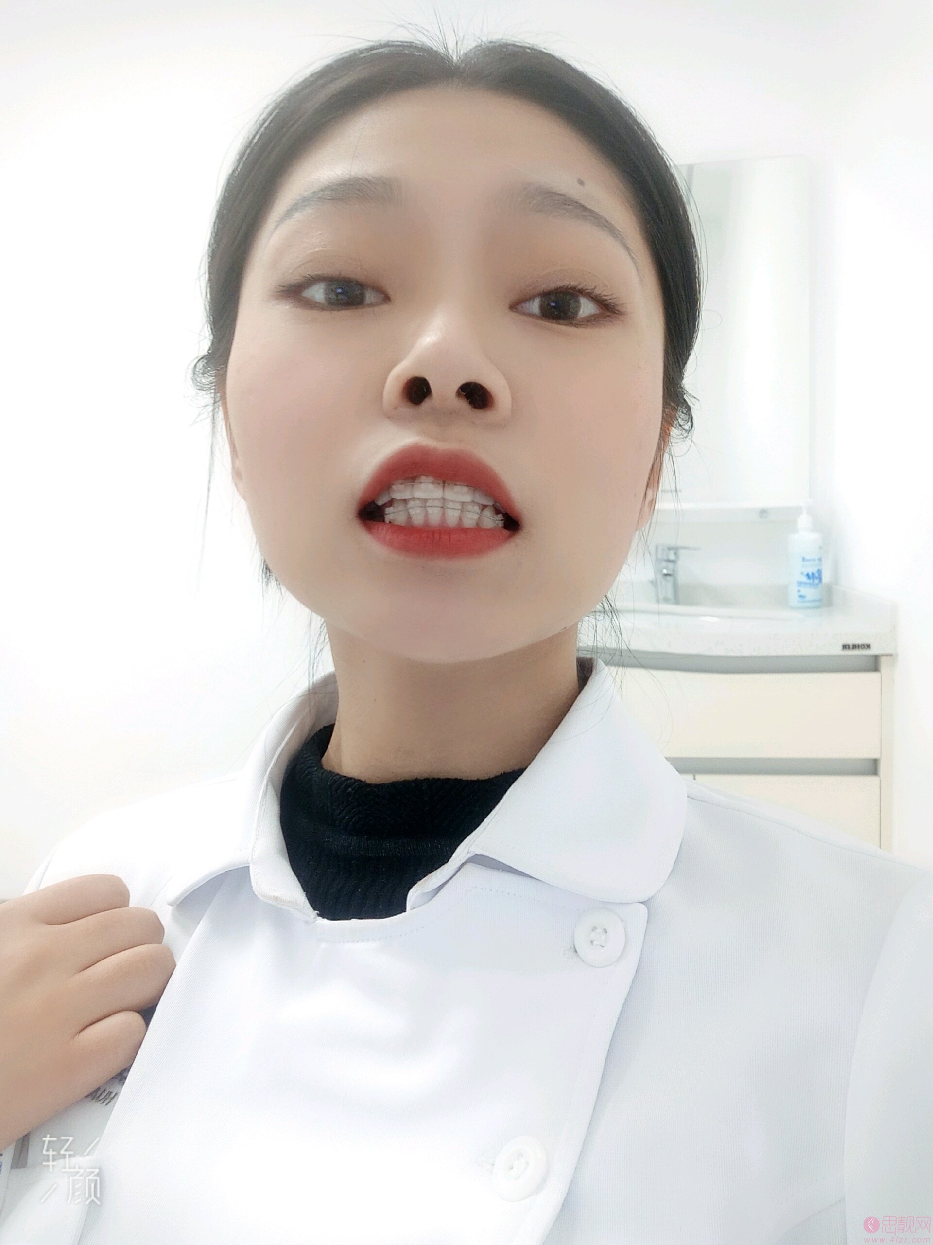青岛维乐口腔孙雪牙齿矫正怎么样？附矫正案例一览+2020价格表曝光