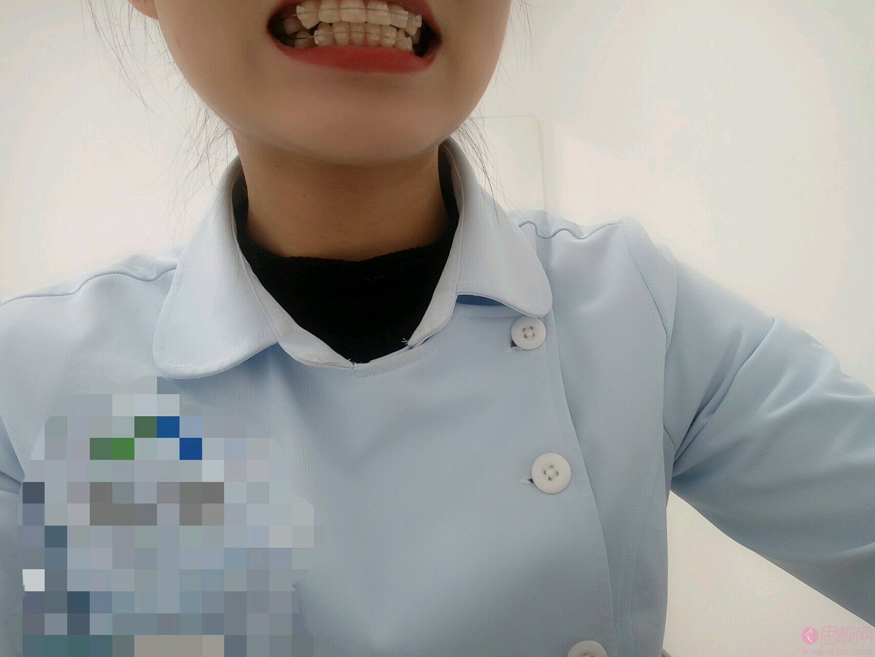 青岛维乐口腔孙雪牙齿矫正怎么样？附矫正案例一览+2020价格表曝光