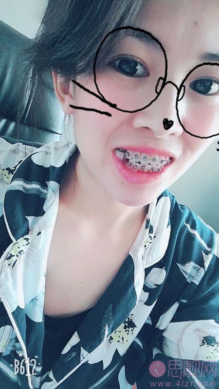 上海伊尔意口腔门诊部王世伟矫正牙齿怎么样？附矫正案例前后对比及2020价格表曝光