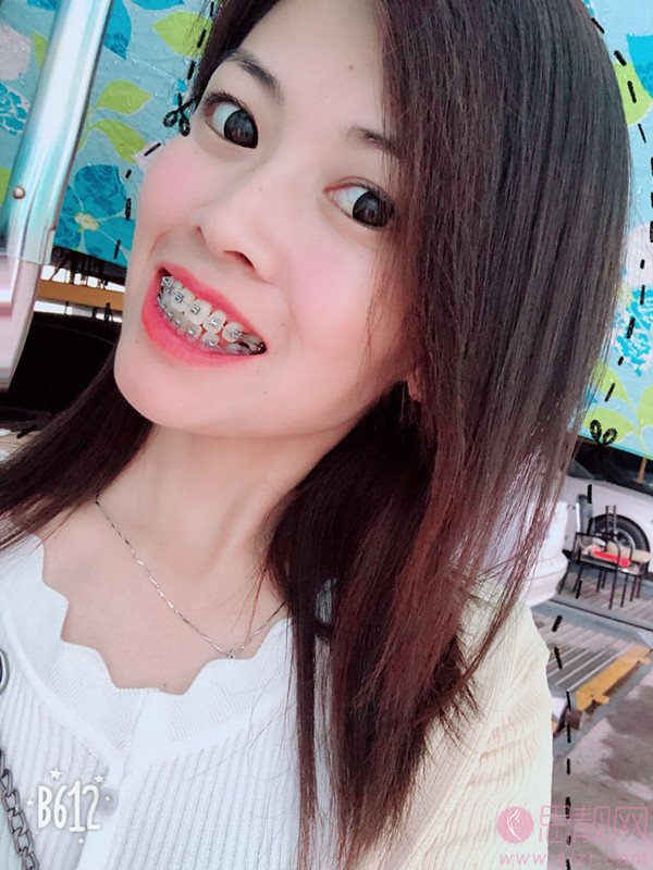 上海伊尔意口腔门诊部王世伟矫正牙齿怎么样？附矫正案例前后对比及2020价格表曝光