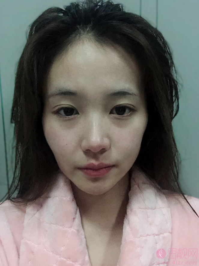 南京美范整形美容陈雪峰自体脂肪全脸填充怎么样？附填充案例对比及2020价格表一览