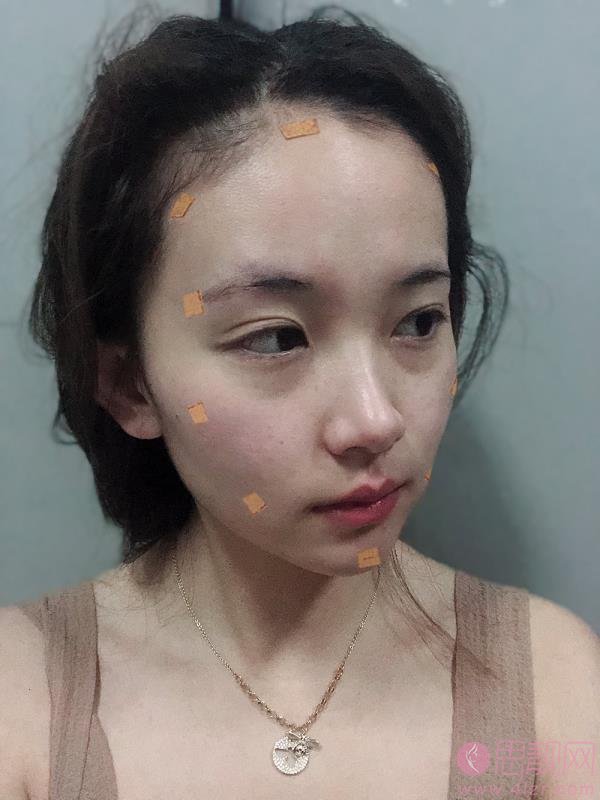 南京美范整形美容陈雪峰自体脂肪全脸填充怎么样？附填充案例对比及2020价格表一览