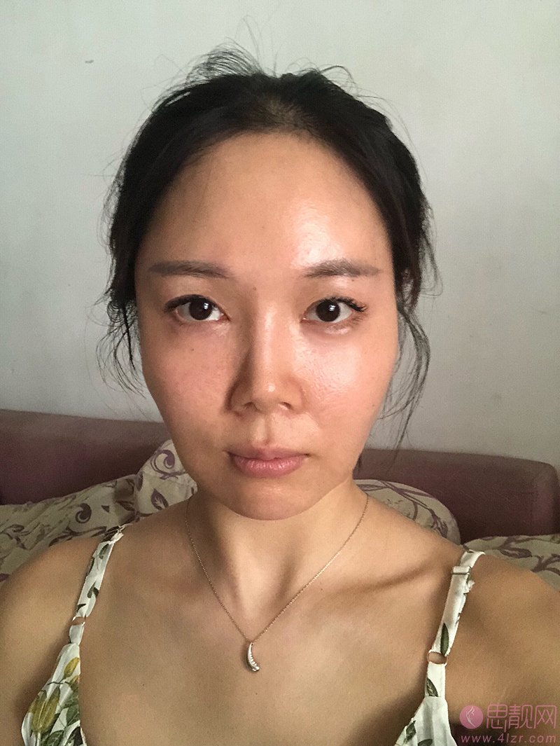 天津和平高丽美迹医疗美容张亚丽医生怎么样？附2020价格表一览+自体脂肪填充全脸案例