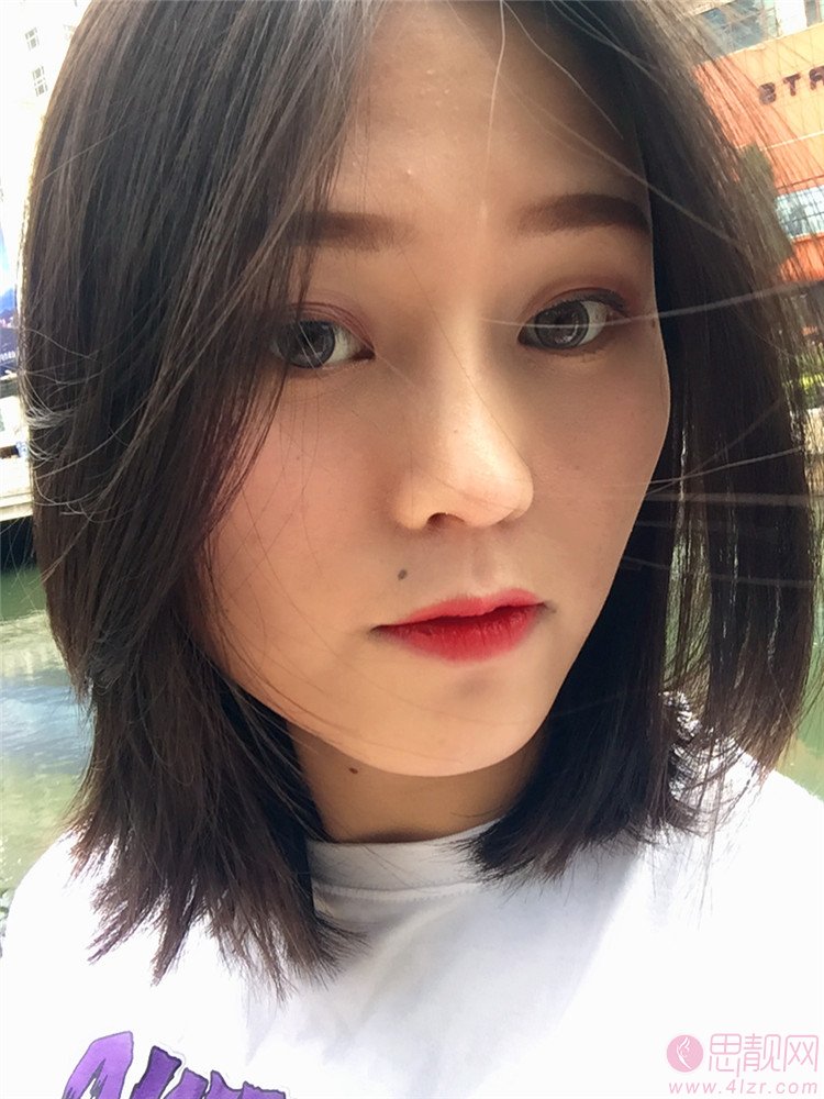 北京蜜邦医疗美容栾志宏隆鼻好不好？附隆鼻案例前后对比及2020价格表曝光