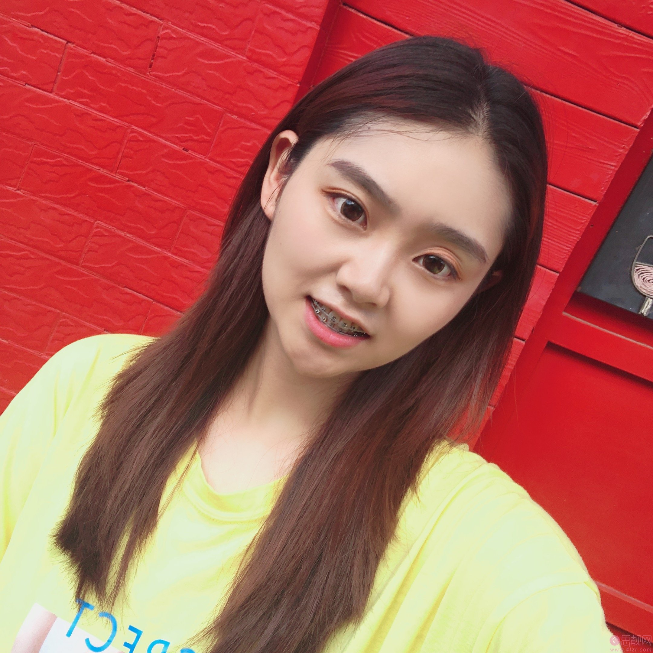重庆瑞泰口腔医院张瑞晶牙齿矫正怎么样？2020价格表曝光+矫正案例前后对比