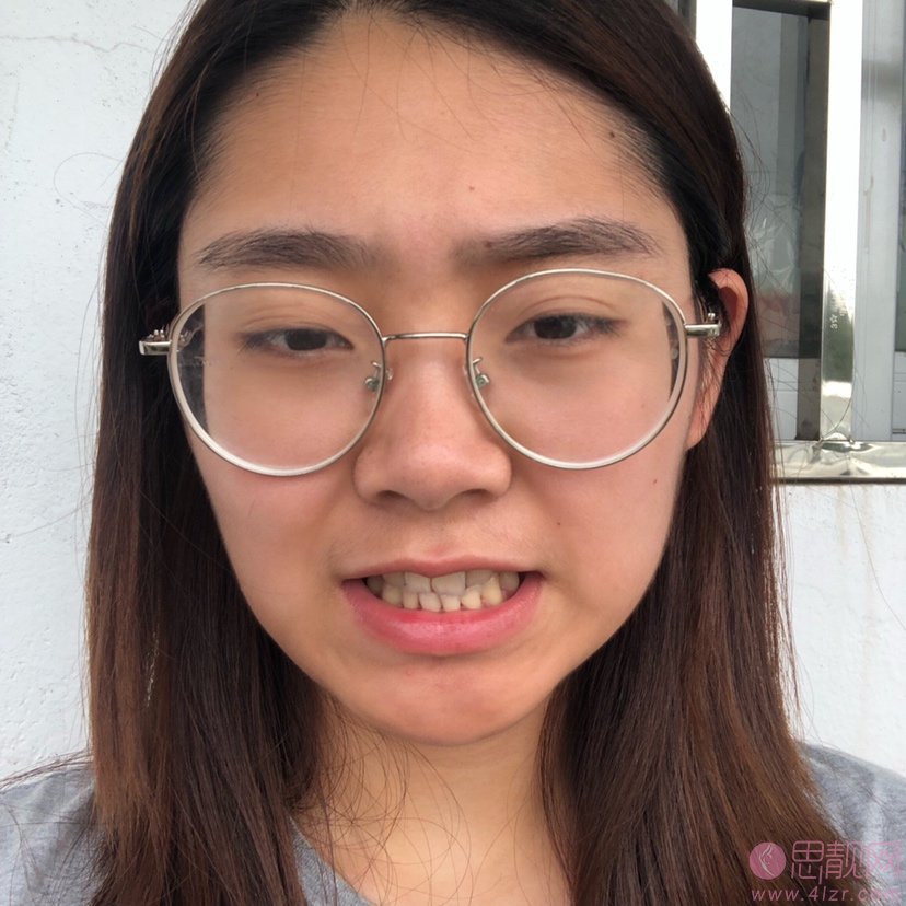 重庆瑞泰口腔医院张瑞晶牙齿矫正怎么样？2020价格表曝光+矫正案例前后对比
