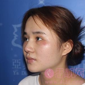 合肥亚典美容医院（原红妆整形）陈录翔隆鼻怎么样？附隆鼻前后案例对比及2020价格表一览