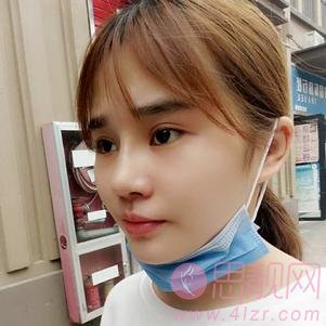 合肥亚典美容医院(原红妆整形)陈录翔隆鼻怎么样?附隆鼻前后案例对比及2020价格表一览