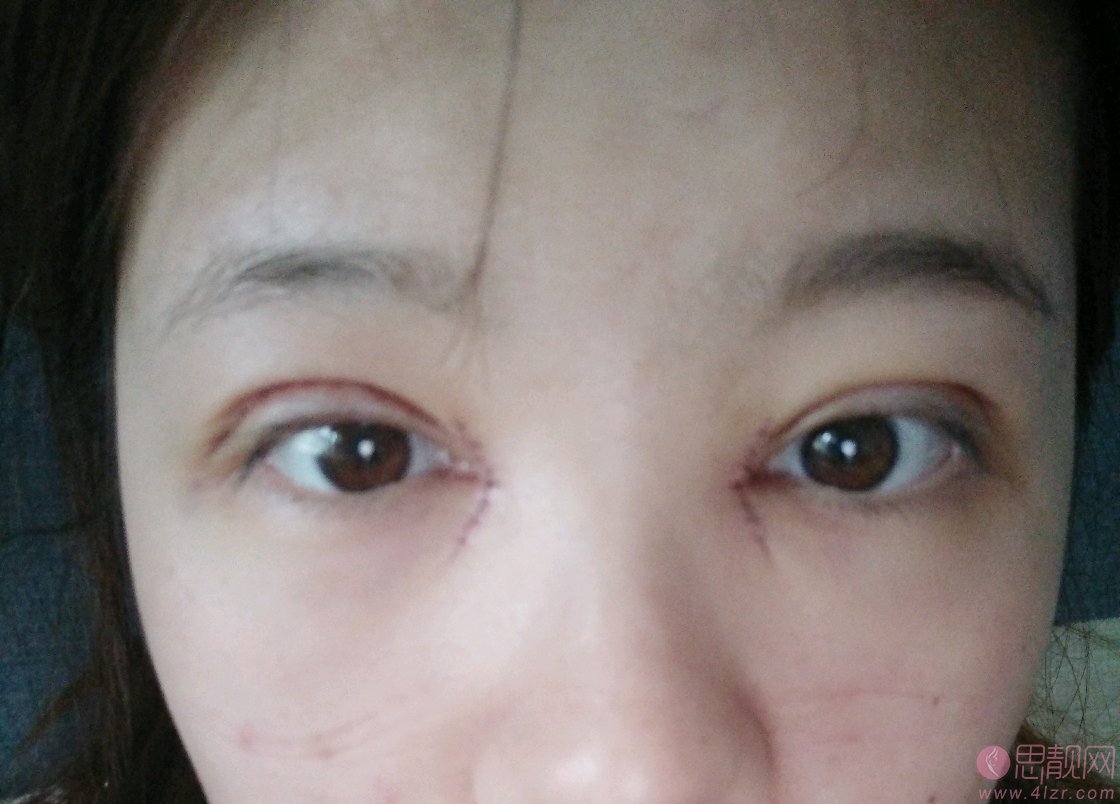 华中科技大学同济医学院医院整形美容陈平医生做双眼皮怎么样/2020价格表曝光