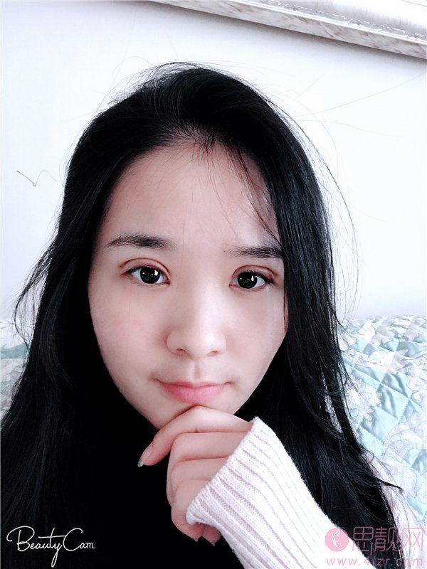 红颜拜博医疗美容闫家峰做双眼皮修复怎么样?附修复案例及2020价格表全新上线