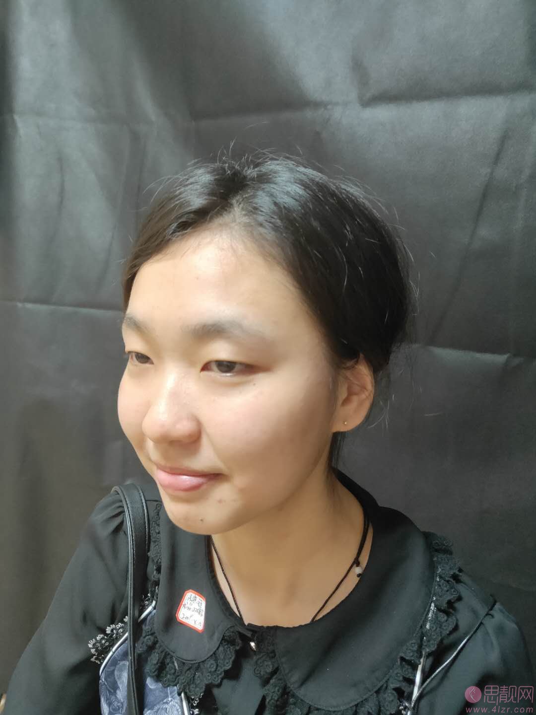 北京华韩整形医院谢立宁做双眼皮好不好？附双眼皮案例及2020价格表曝光