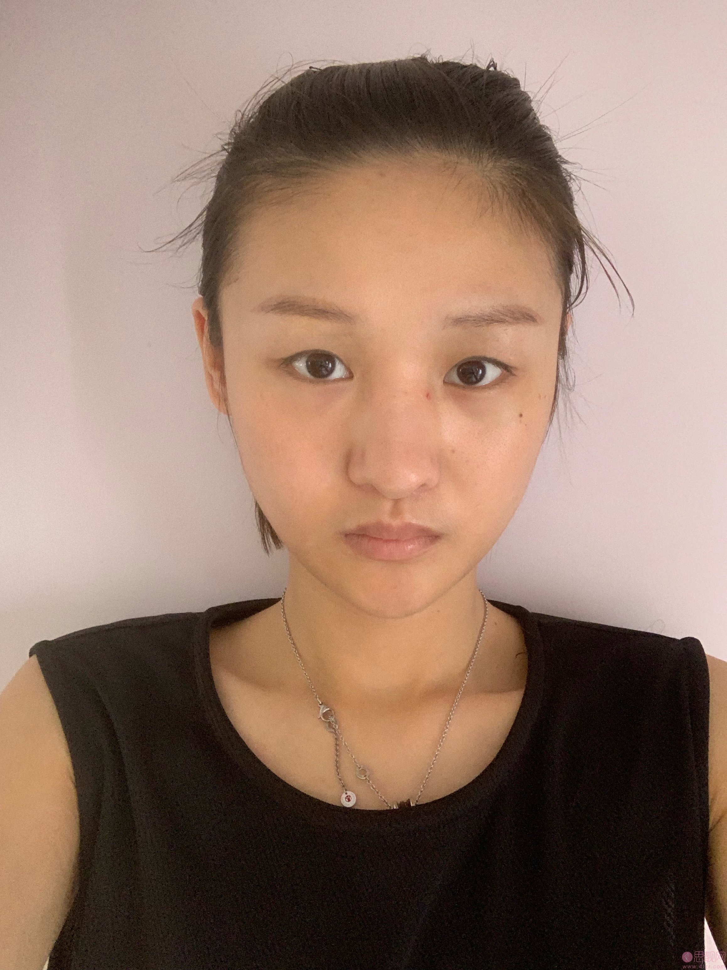 温州美域高医疗美容李自银做双眼皮怎么样？2020价格表曝光+双眼皮案例真人展示