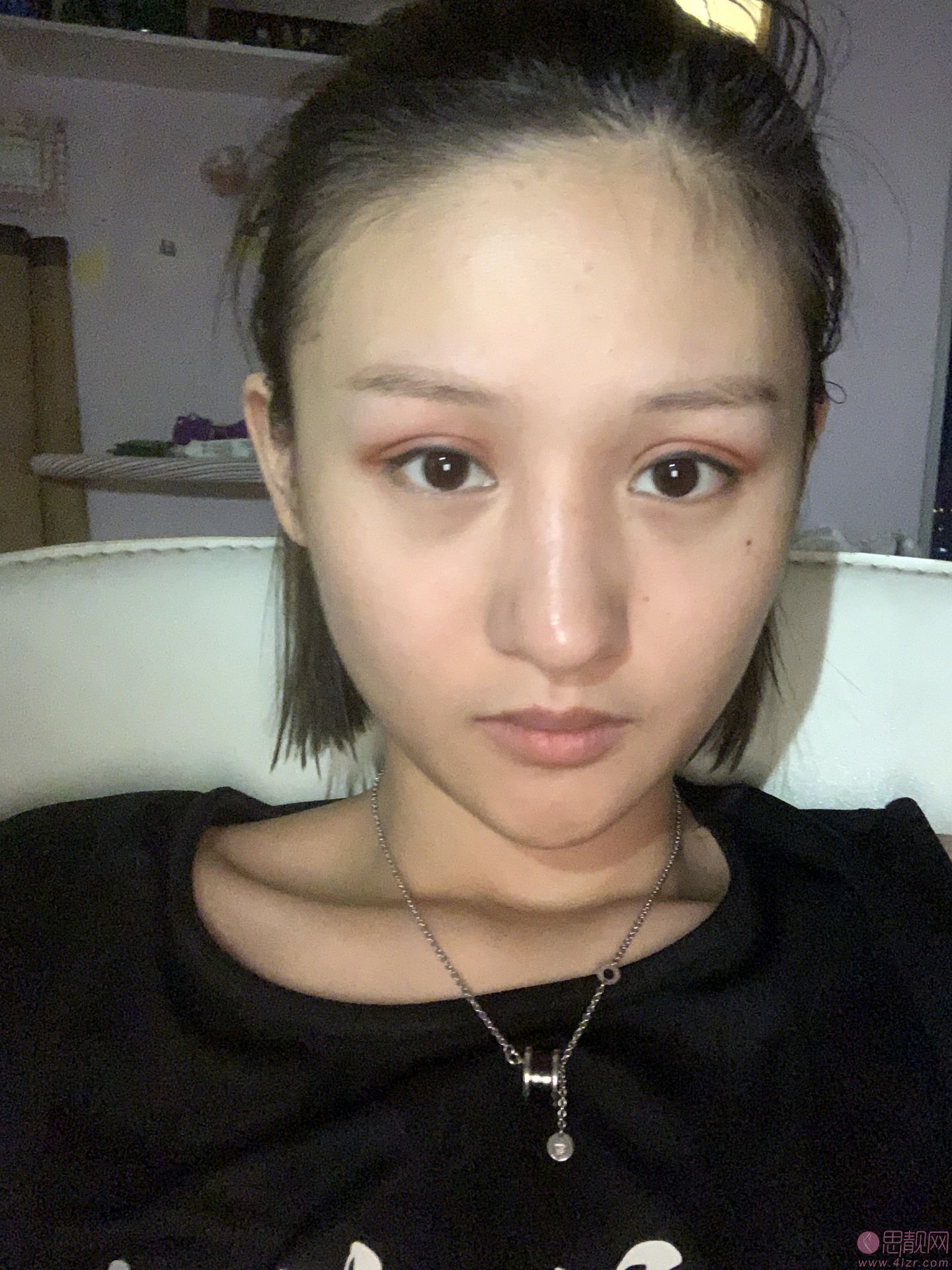 温州美域高医疗美容李自银做双眼皮怎么样？2020价格表曝光+双眼皮案例真人展示