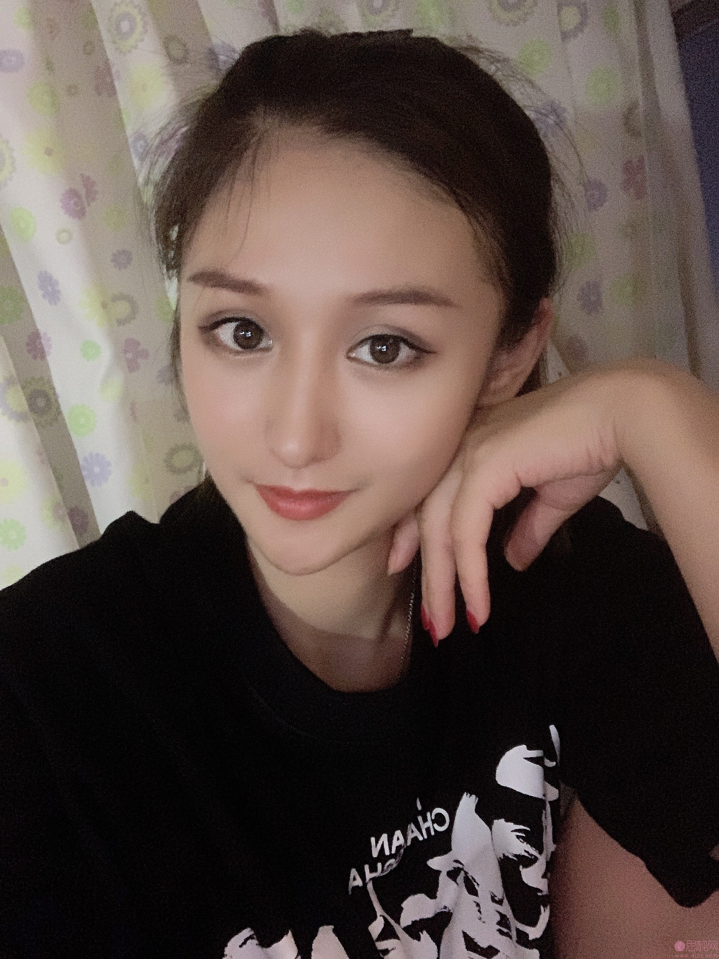 温州美域高医疗美容李自银做双眼皮怎么样？2020价格表曝光+双眼皮案例真人展示
