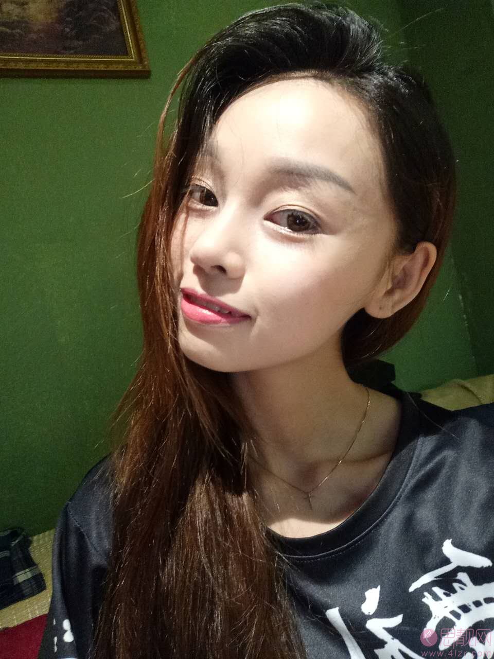 南阳三院医疗美容科隆鼻怎么样？附隆鼻真人案例分享及2020价格表一览