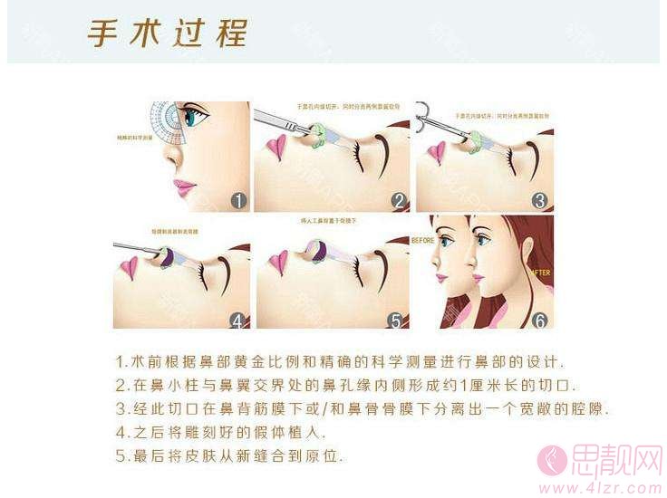 隆鼻疼吗?手术切口会留疤吗?