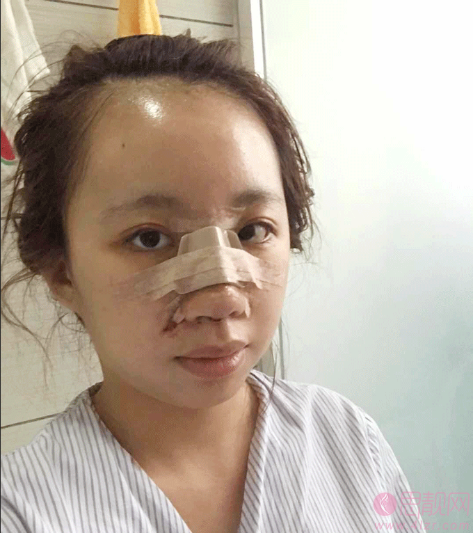 中山韩妃医疗美容门诊部隆鼻如何？2020价格表全新上线+隆鼻真人案例分享