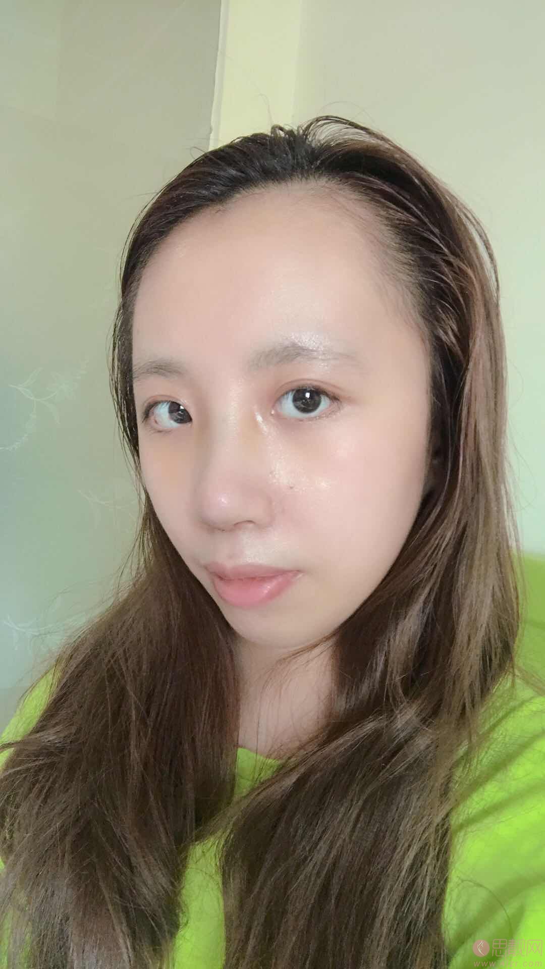 中山韩妃医疗美容门诊部隆鼻如何？2020价格表全新上线+隆鼻真人案例分享