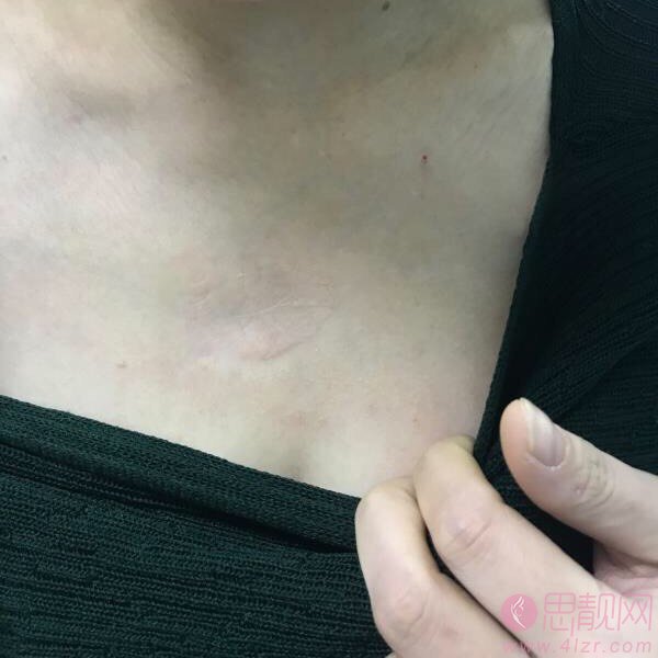 广东药科大学附属第三医院祛斑怎么样？2020价格表全新上线+祛斑案例一览