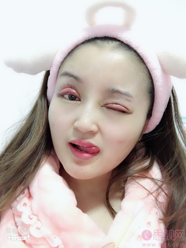 上海安缦医疗美容严彪做双眼皮怎么样？附双眼皮案例一览及2020价格表曝光