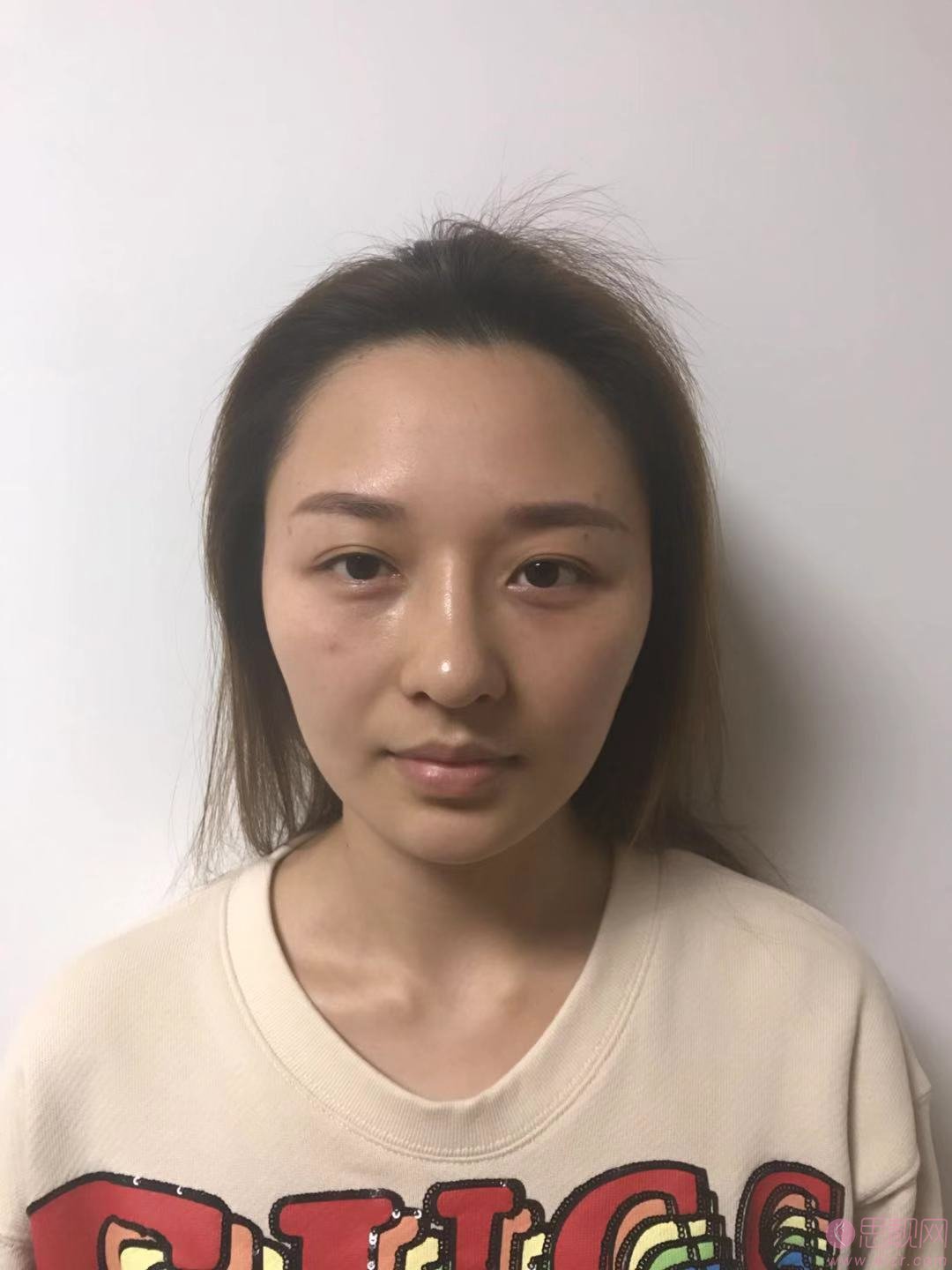 上海百达丽医疗美容顾清隆鼻好不好？附隆鼻真人案例分享及2020价格表一览