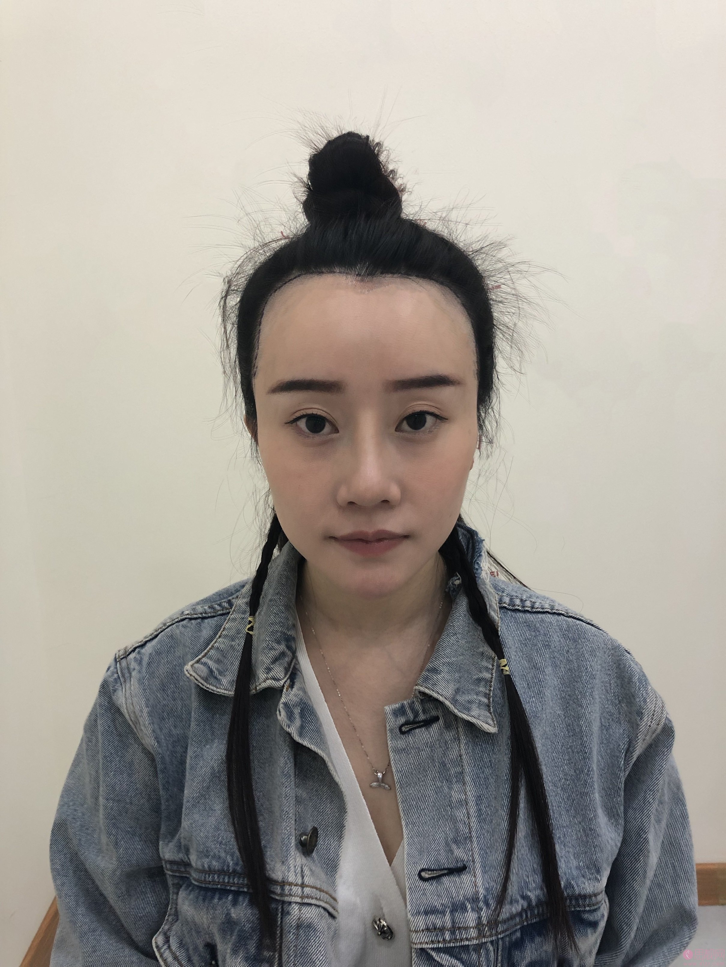上海碧莲盛无痕植发周宗贵种植发际线多少钱？附2020价格表最新出炉及种植真人案例分享