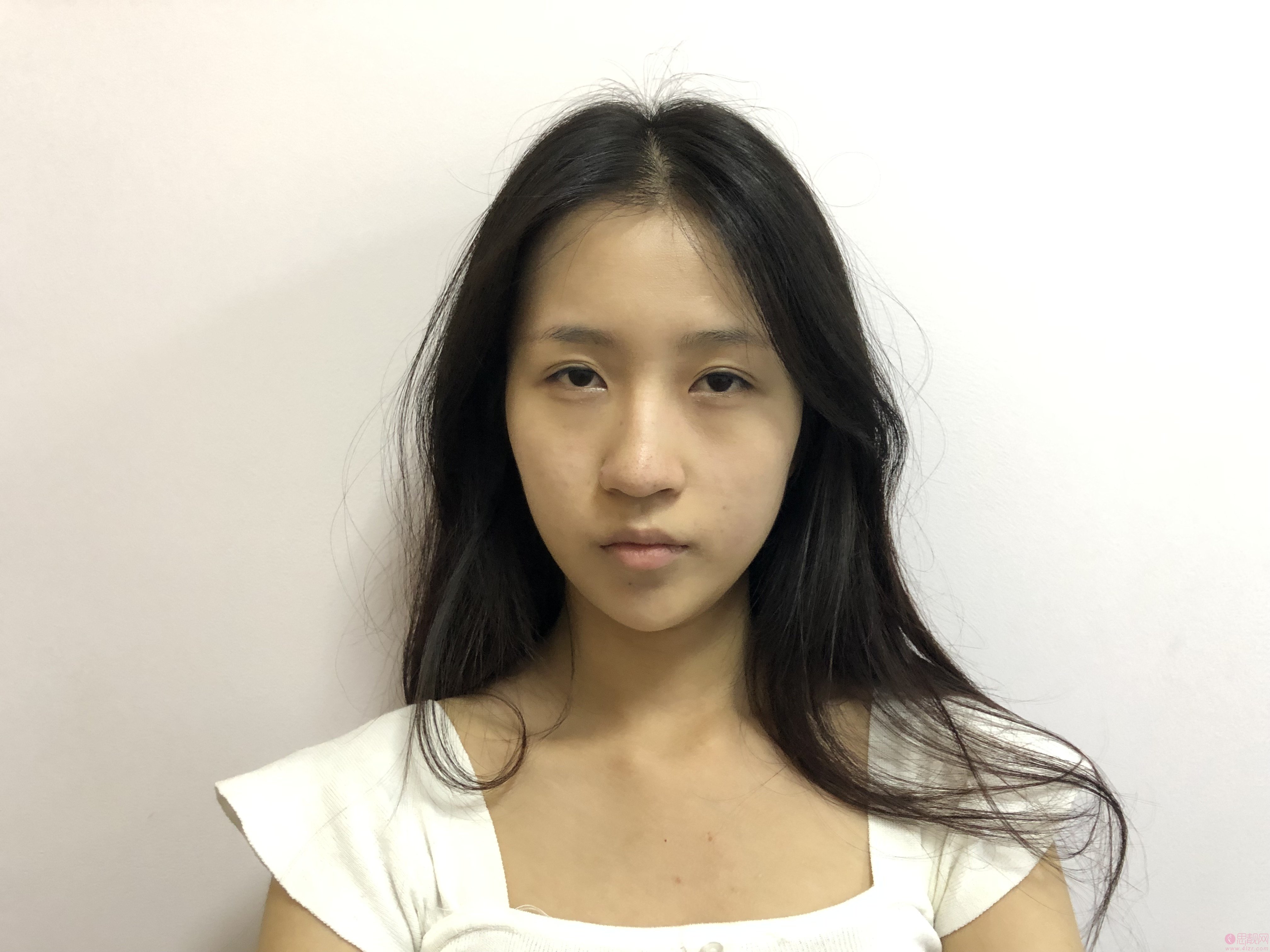 上海铂曼医疗美容谢敏凯隆鼻怎么样？2020价格表一览+隆鼻案例真人分享