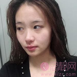 上海宏康医院隆鼻怎么样？2020价格表一览+隆鼻真人分享