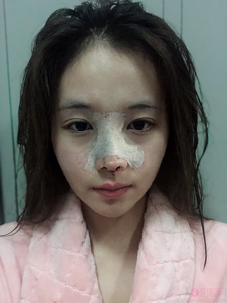 上海宏康医院隆鼻怎么样？2020价格表一览+隆鼻真人分享