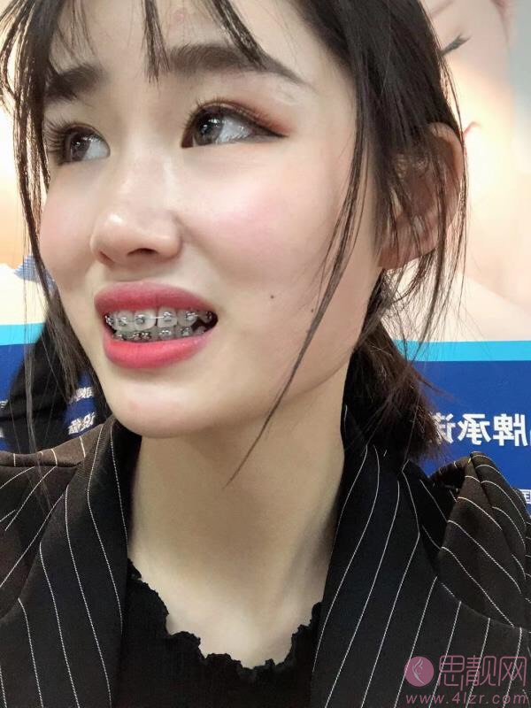 嘉悦口腔（洋河门诊）牙齿矫正怎么样？附牙齿矫正真人分享及2020价格表一览