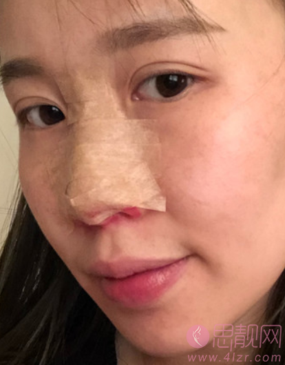 成都韩艺医学美容隆鼻怎么样？2020价格表一览+隆鼻真人分享案例