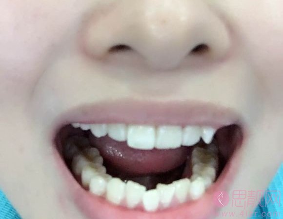 上海佳沪口腔门诊部矫正牙齿贵吗？2020价格表一览