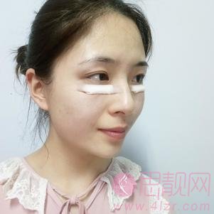 上海健丽医疗美容（原上海逆时针）李应激光祛眼袋怎么样？附祛眼袋前后对比案例及2020价格表一览