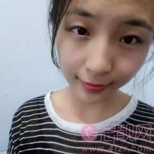 上海健丽医疗美容（原上海逆时针）李应激光祛眼袋怎么样？附祛眼袋前后对比案例及2020价格表一览