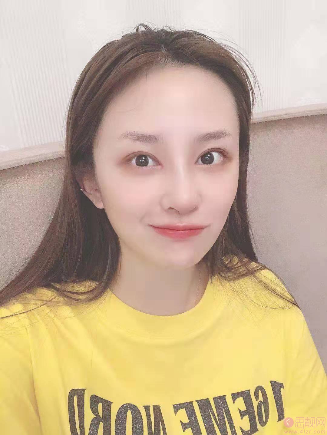 成都米亚医疗美容整形门诊部隆鼻多少钱？2020价格表曝光+隆鼻真人分享
