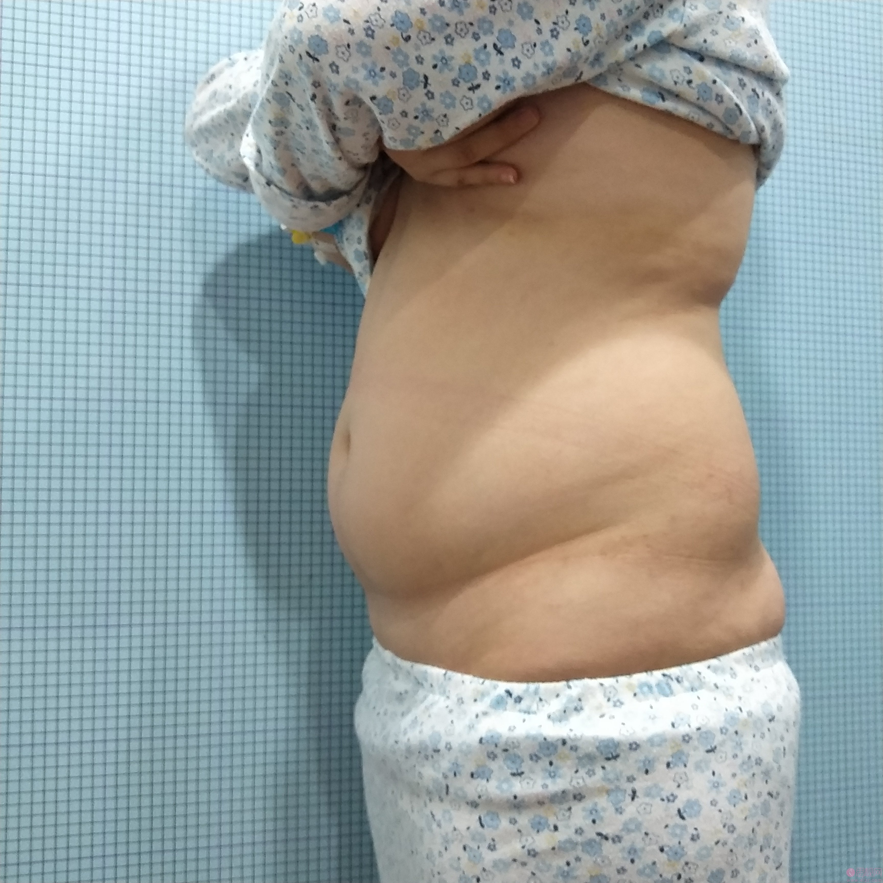 厦门新开元医疗美容腰腹吸脂怎么样？附吸脂案例真人分享及2020价格表一览
